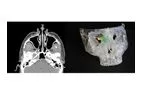 Axial3d - Solution for Craniomaxillofacial Surgery