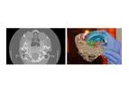 Axial3d - Transforming Treatment Solution for Craniomaxillofacial Neurosurgery