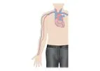 Amplifi - Vein Dilation System