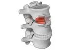 Parametrics - Model Demineralized Bone Matrix (DBM) - Bone Grafts
