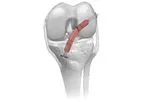 Coll-e-Strong - Allograft Tendons
