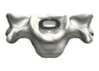 Tyber - Anterior Cervical Interbody Fusion (ACIF)