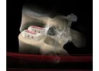 Alamo - Model P - Posterior Lumbar Intervertebral Device