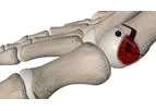 MINIBunion - Minimally Invasive Implant