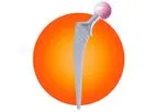 Biotechni - Model Filler-3ND - Femoral Stem for Total Hip Arthroplasty and Hemiarthroplasty
