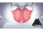 Emsella - Incontinence