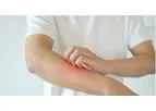 Model LT5001 - Uremic Pruritus