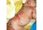 InMed - Model INM-755 - Cannabinol Topical Cream for the Treatment of Epidermolysis Bullosa