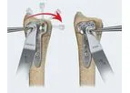Avanti - Distal Radius Fracture Fixation