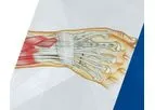 Avanti - Wrist Spanning and Fusion