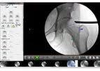 Surgeon Checklist - Version FAI - Minimally-Invasive Solutions for Hip Arthroscopy