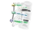Inertia - Pedicle Screw System