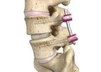 OptiMesh - Expandable Interbody Fusion System