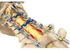 SpineWave Proficient - Posterior Cervical Spine System