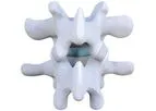 Zenfuze - Lumbar Fusion System