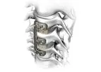 Atlas - Model Verteview - Cervical Plating System