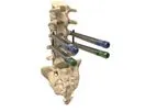 Thunderbolt - Minimally Invasive Pedicle Screw System