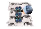 GRUVE - Anterior Cervical Plate System