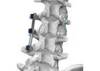 Life Spine - Model ARx - Spinal Fixation System