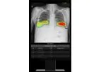 Lunit - Version INSIGHT CXR - AI Solution for Chest X-ray