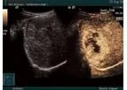 Ultrasound