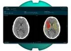 Brainomix - Version e-ASPECTS - Transforming Stroke Care Through Simple Imaging