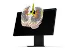 Brainomix - Version e-ILD - AI-Powered Solution for Assessment of Interstitial Lung Disease (ILD)