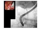 Diagnostic ERCP Software of Image Analysis and AI