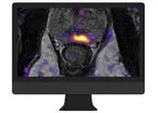 OnQ Prostate - Breakthrough Software Supporting Improved Prostate Cancer Detection