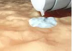 Palvella - Model QTORIN - Pachyonychia Congenita (PC)