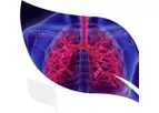 Ibio - Model 100 - Idiopathic Pulmonary Fibrosis [IPF] Therapeutics