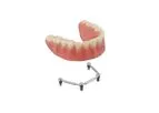 Dental implants Prothetics
