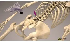 OmniBone Bone Marrow Biopsy Power - Video