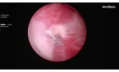 Median Lobe ThuLEP using the MultiPulse Tm+1470 by JenaSurgical - Video