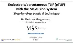 Endoscopic percutaneous TLIF (pTLIF) with MaxFusion System - Video