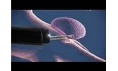 Cellvizio in Lung Nodules Video