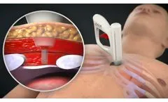 AtaCor Medical Temporary & Permanent Pacing System - Video