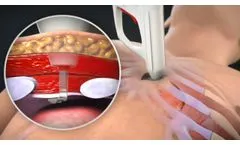 AtaCor Medical Intracostal Pacing System - Video