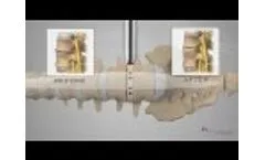 NuVasive® XLIF® Patient Animation - Video