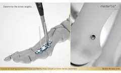 APTUS Foot Hallux System 2 8 Hallux Arthrodesis MTP 1 Fusion - Video