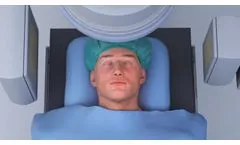 Neuro Thrombectomy Procedure with 3D Revascularization Device - Vieo