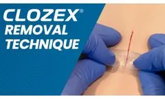 Clozex Removal Technique - Video