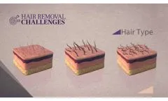 SHR 3D Technology - Soprano Laser Hair Removal - Video