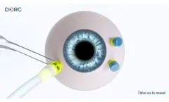 EVA AVETA??? trocar cannula system by DORC - Video
