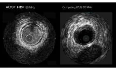 HDi - Circumflex Calcium - Video