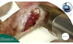 Wound Healing Cases Collection - Case 01 Surgical Dehiscence - Video