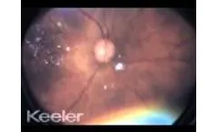 ROP Dark fundus mini clip - Video