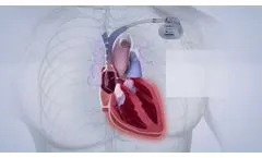 BIOTRONIK Closed Loop Stimulation Offers the Most Physiological Rate Regulation* - Video