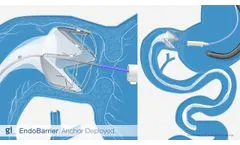 EndoBarrier - Placement, Action and Removal - Video