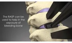 Discovery Cervical System Surgical Technique Guide - Video
